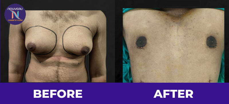 Gynecomastia before after