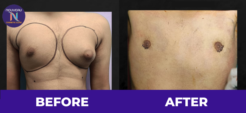 Gynecomastia in indore