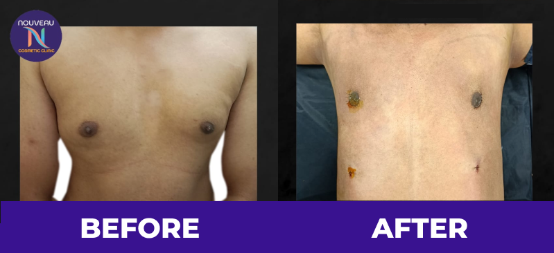 Gynecomastia patient before after