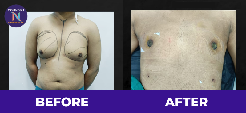 Gynecomastia real photo