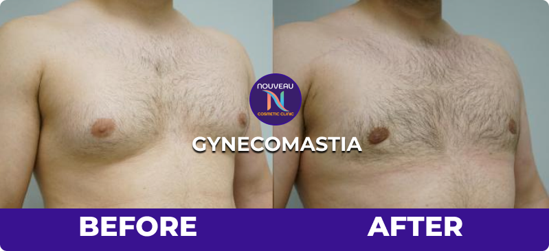 gynecomastia before after