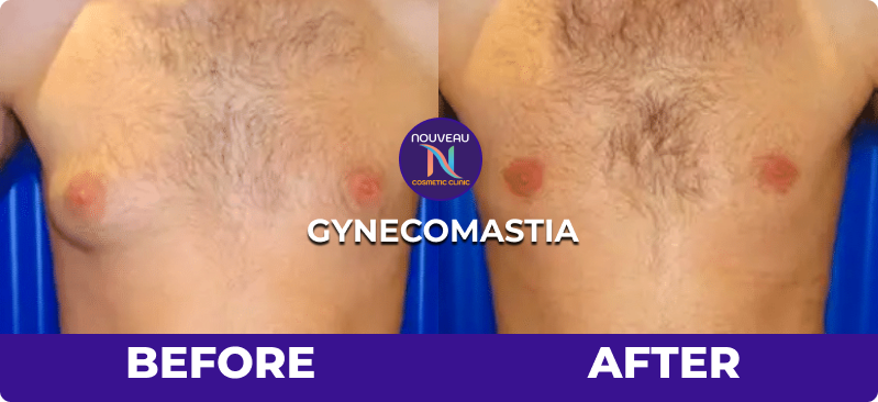 gynecomastia before and after