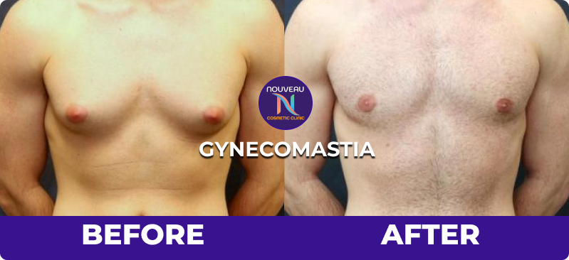 gynecomastia patient before after