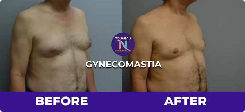 gynecomastia before after image