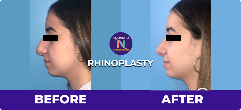 rhinoplasty in indore