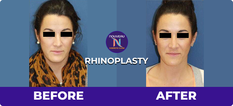 Rhinoplasty in Indore