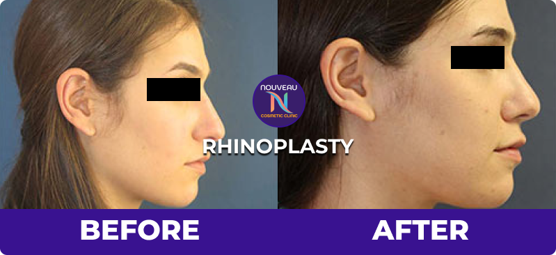 rhinoplasty before after