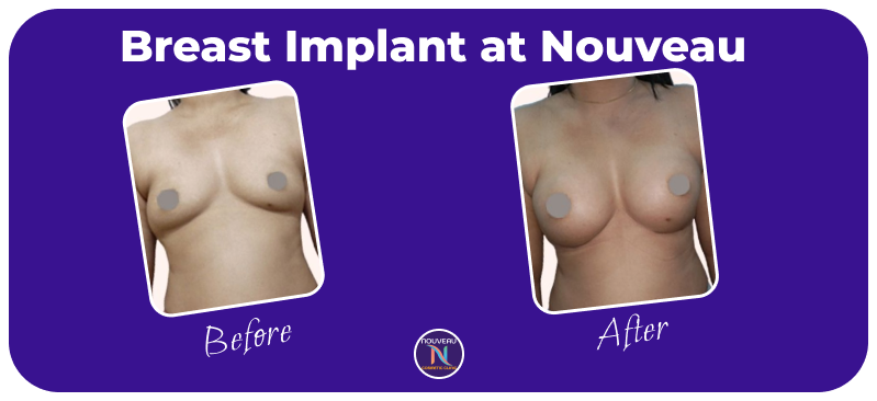 breast augmentation in indore