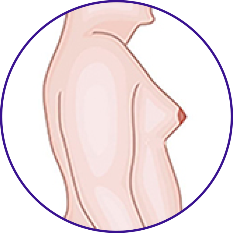 gynecomastia surgery in indore