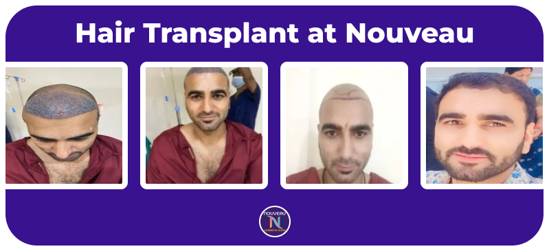 hair-transplant result-3