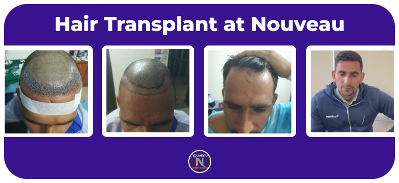 hair-transplant result