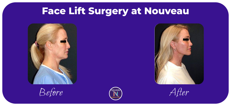 facelift surgery in indore-1