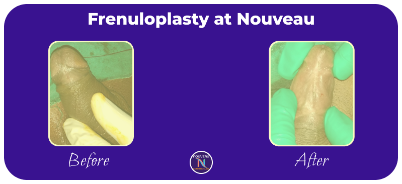 frenuloplasty in indore-1