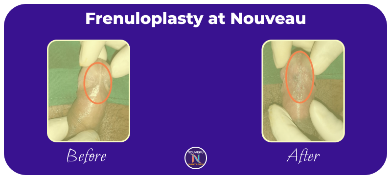 frenuloplasty in indore-3